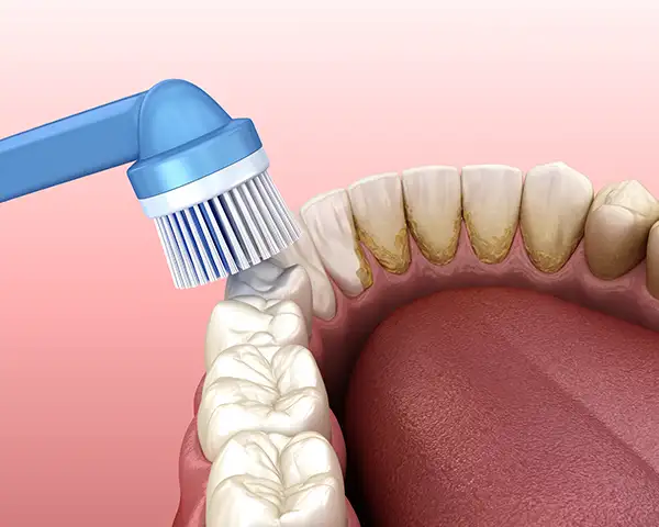 Close-up of an electric toothbrush moving over some dirty teeth to remove plaque.